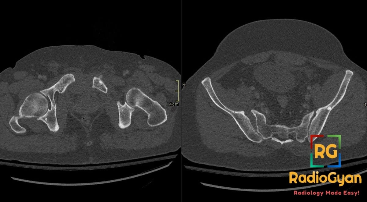 Axial CT pelvis showing pubic symphysis diastasis and right sacroiliac joint widening after MVC trauma