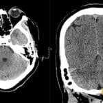 Non-contrast CT brain showing right cerebellar hypodensity consistent with right superior cerebellar artery infarct