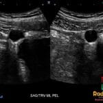 Transabdominal ultrasound showing a small anechoic urachal cyst anterosuperior to the urinary bladder