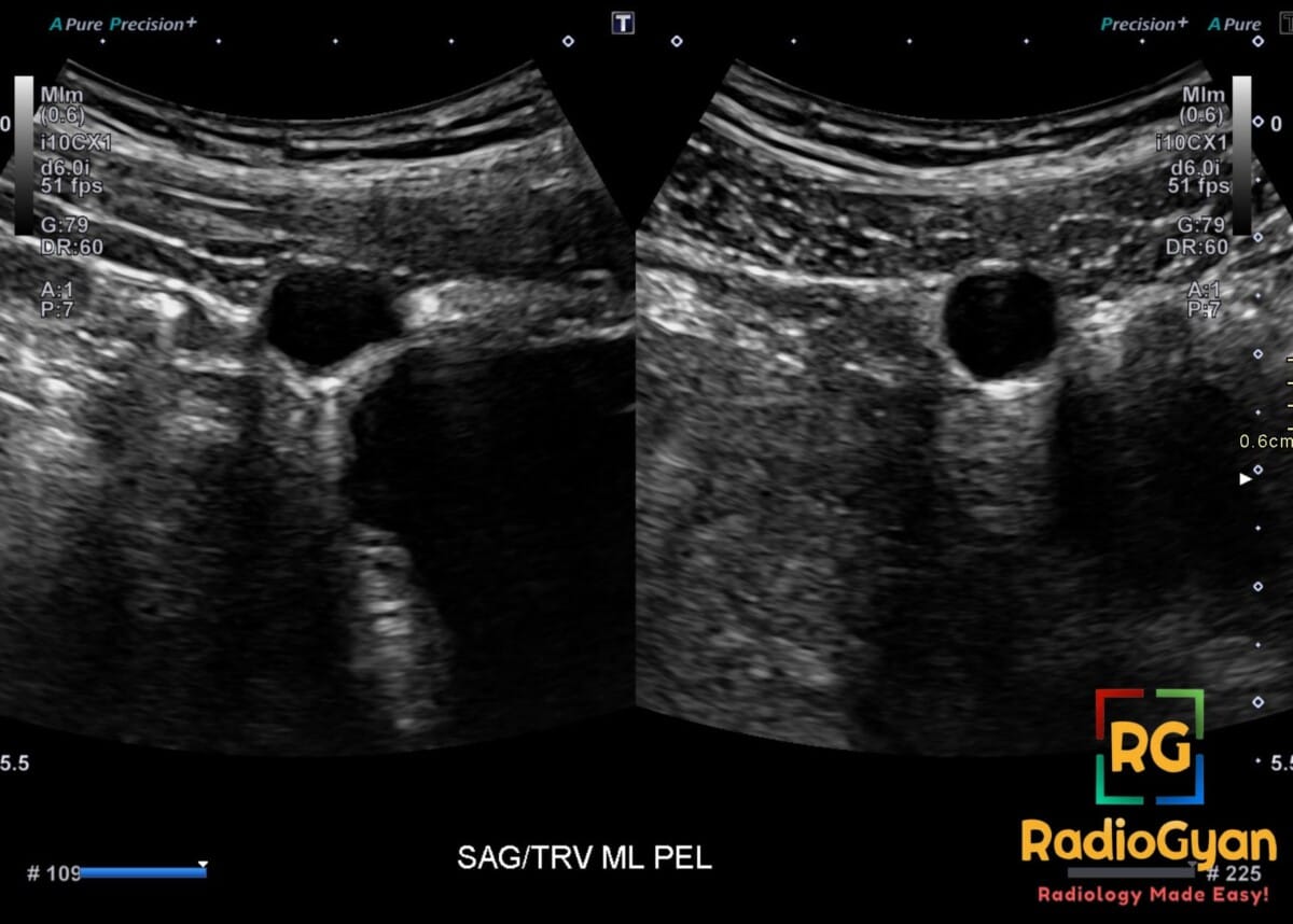 Transabdominal ultrasound showing a small anechoic urachal cyst anterosuperior to the urinary bladder
