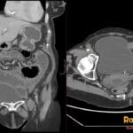 Coronal and axial CT of abdomen and pelvis showing small bowel obstruction from left femoral hernia with narrowed left femoral vein