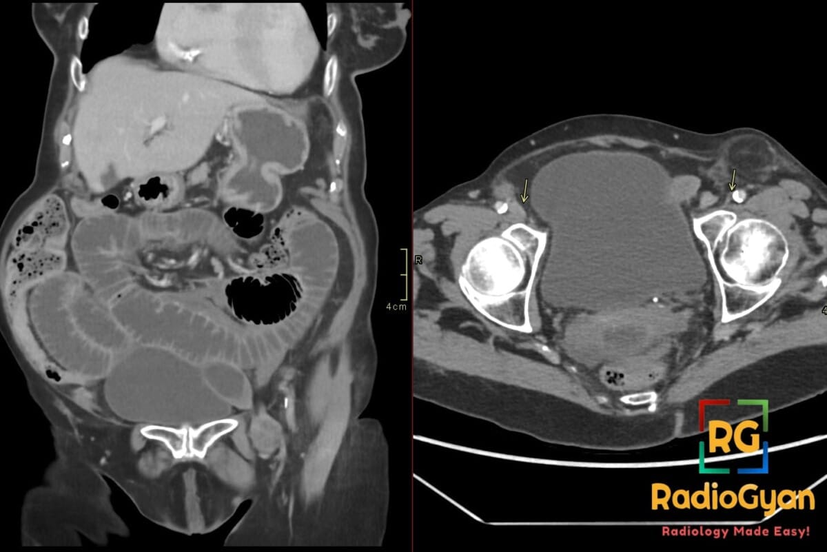 Coronal and axial CT of abdomen and pelvis showing small bowel obstruction from left femoral hernia with narrowed left femoral vein
