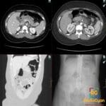 Axial and coronal CT showing acute interstitial pancreatitis with colon cut-off sign at the splenic flexure