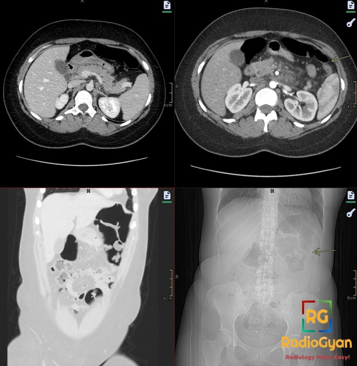 Axial and coronal CT showing acute interstitial pancreatitis with colon cut-off sign at the splenic flexure