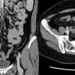 Coronal and axial CT scans of the abdomen showing aneurysmal left lower quadrant small bowel dilatation from lymphoma.