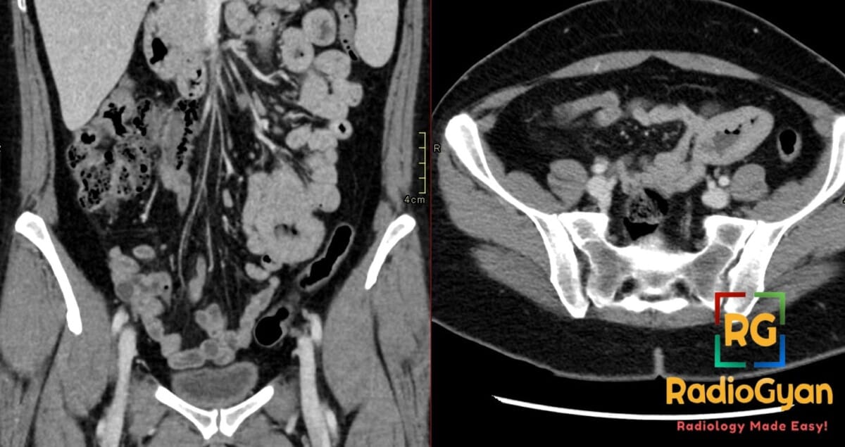 Coronal and axial CT scans of the abdomen showing aneurysmal left lower quadrant small bowel dilatation from lymphoma.