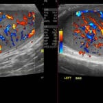 Sagittal color Doppler ultrasound showing bilateral testicular orchitis with marked hyperemia in the right and left testes
