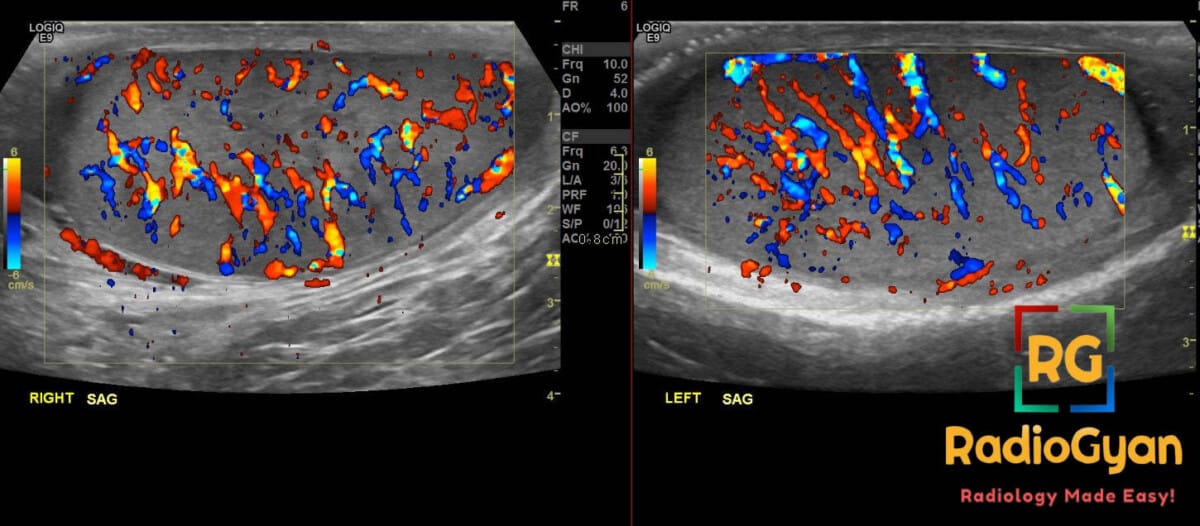 Sagittal color Doppler ultrasound showing bilateral testicular orchitis with marked hyperemia in the right and left testes