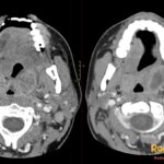 Axial contrast-enhanced neck CT scan showing bilateral tonsillar swelling and a left peritonsillar rim-enhancing fluid collection.