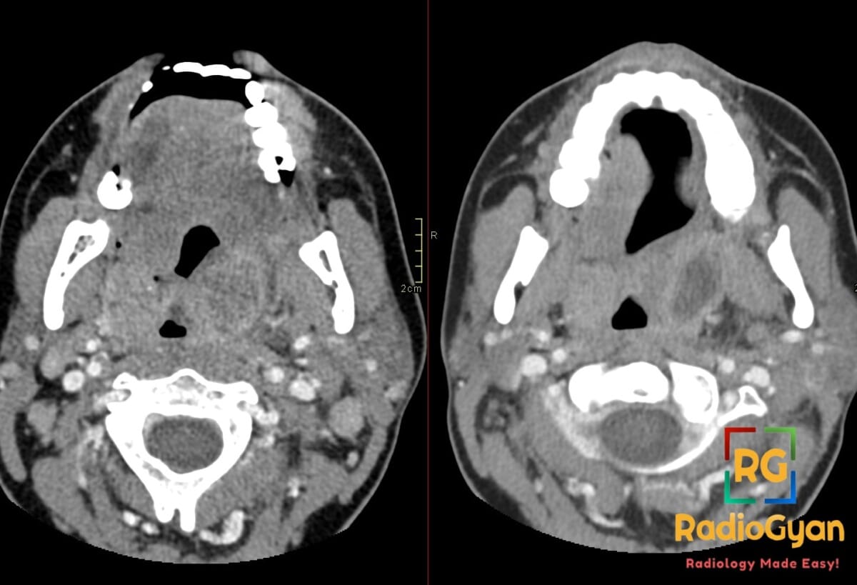 Axial contrast-enhanced neck CT scan showing bilateral tonsillar swelling and a left peritonsillar rim-enhancing fluid collection.