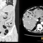 Coronal and axial abdominal CT demonstrating pneumatosis intestinalis and portal venous gas from extensive bowel ischemia