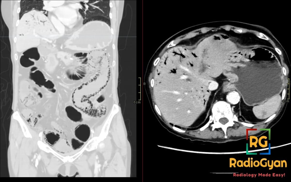 Coronal and axial abdominal CT demonstrating pneumatosis intestinalis and portal venous gas from extensive bowel ischemia