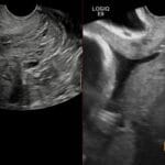 Sagittal transvaginal ultrasound shows interval cervical funneling and Y-shaped internal os with 2.8 cm cervical length