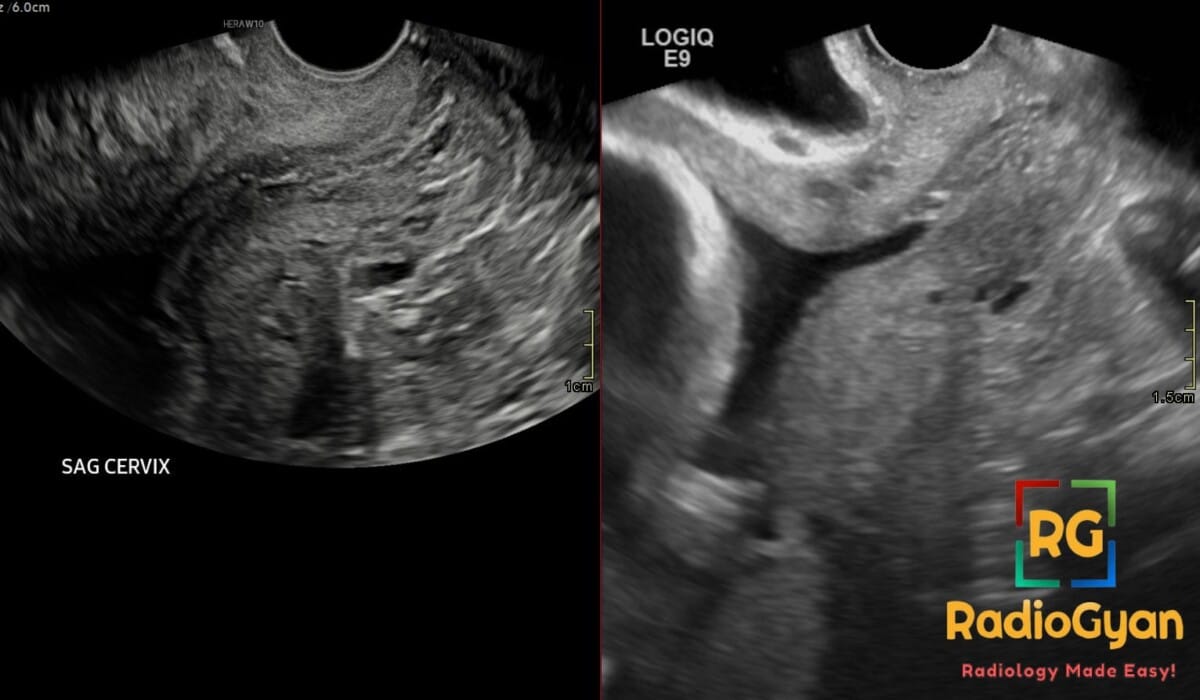 Sagittal transvaginal ultrasound shows interval cervical funneling and Y-shaped internal os with 2.8 cm cervical length