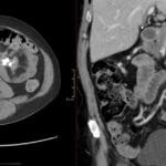 Axial and coronal contrast CT images show a calcified central mesenteric mass with fat-ring sign in chronic sclerosing mesenteritis.