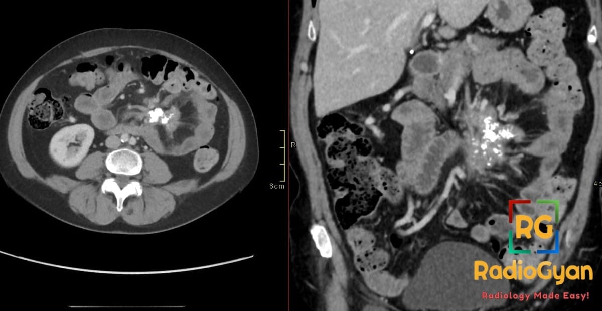 Axial and coronal contrast CT images show a calcified central mesenteric mass with fat-ring sign in chronic sclerosing mesenteritis.