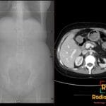 Axial abdominal CT in cystic fibrosis shows fatty distal pancreatic replacement; scout shows clam-shell sternotomy wires.