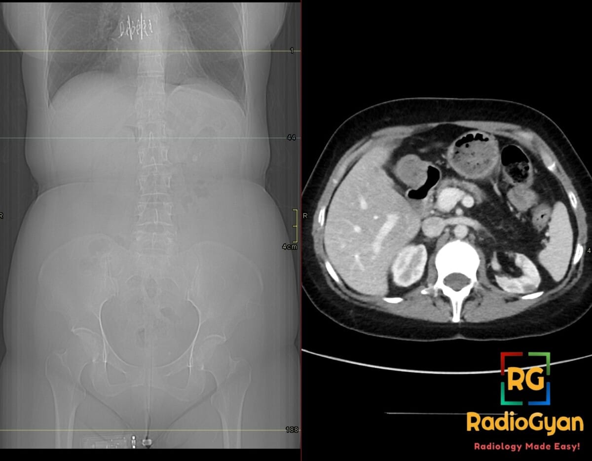 Axial abdominal CT in cystic fibrosis shows fatty distal pancreatic replacement; scout shows clam-shell sternotomy wires.