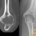 Coronal CT and AP radiograph show a distal humeral giant cell tumor in a skeletally mature patient, with expansile osteolysis.