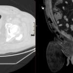 Axial and coronal CT of the pelvis showing Fournier gangrene with bilateral subcutaneous gas and soft tissue swelling.