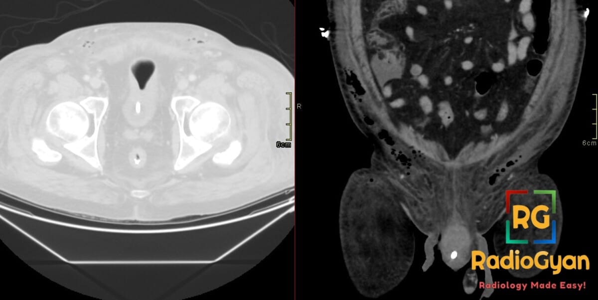 Axial and coronal CT of the pelvis showing Fournier gangrene with bilateral subcutaneous gas and soft tissue swelling.