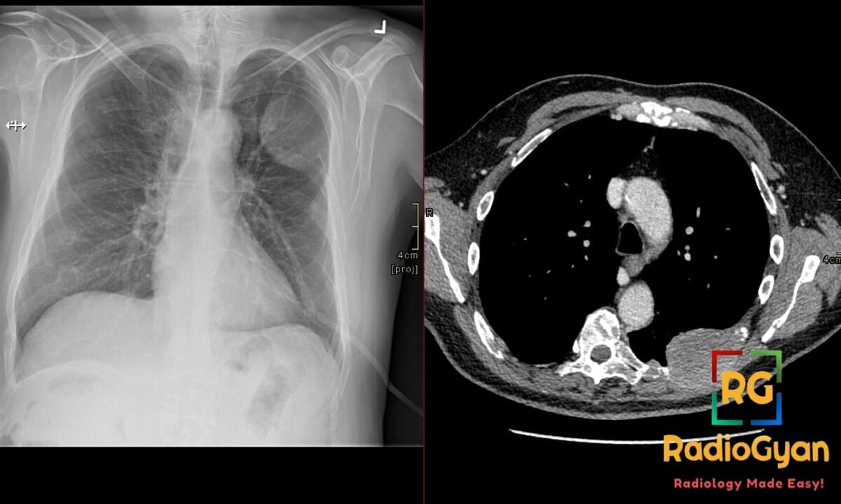 Frontal chest radiograph and axial CT show an expansile left upper rib lesion with the incomplete-border sign.
