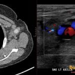 Axial CT and sagittal Doppler ultrasound show a left axillary nodal pseudoaneurysm with central enhancement, yin-yang flow