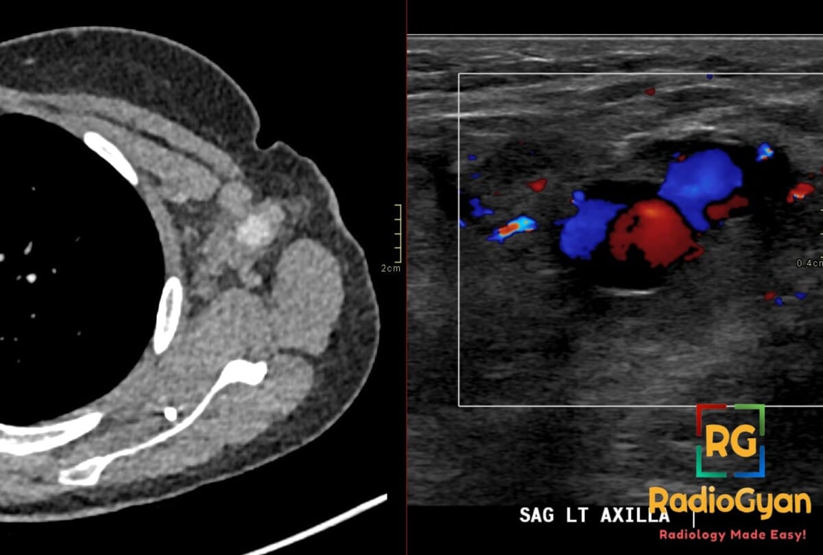 Axial CT and sagittal Doppler ultrasound show a left axillary nodal pseudoaneurysm with central enhancement, yin-yang flow