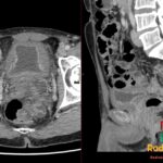 Axial and sagittal pelvic CT showing severe diffuse urinary bladder wall thickening with reduced capacity.