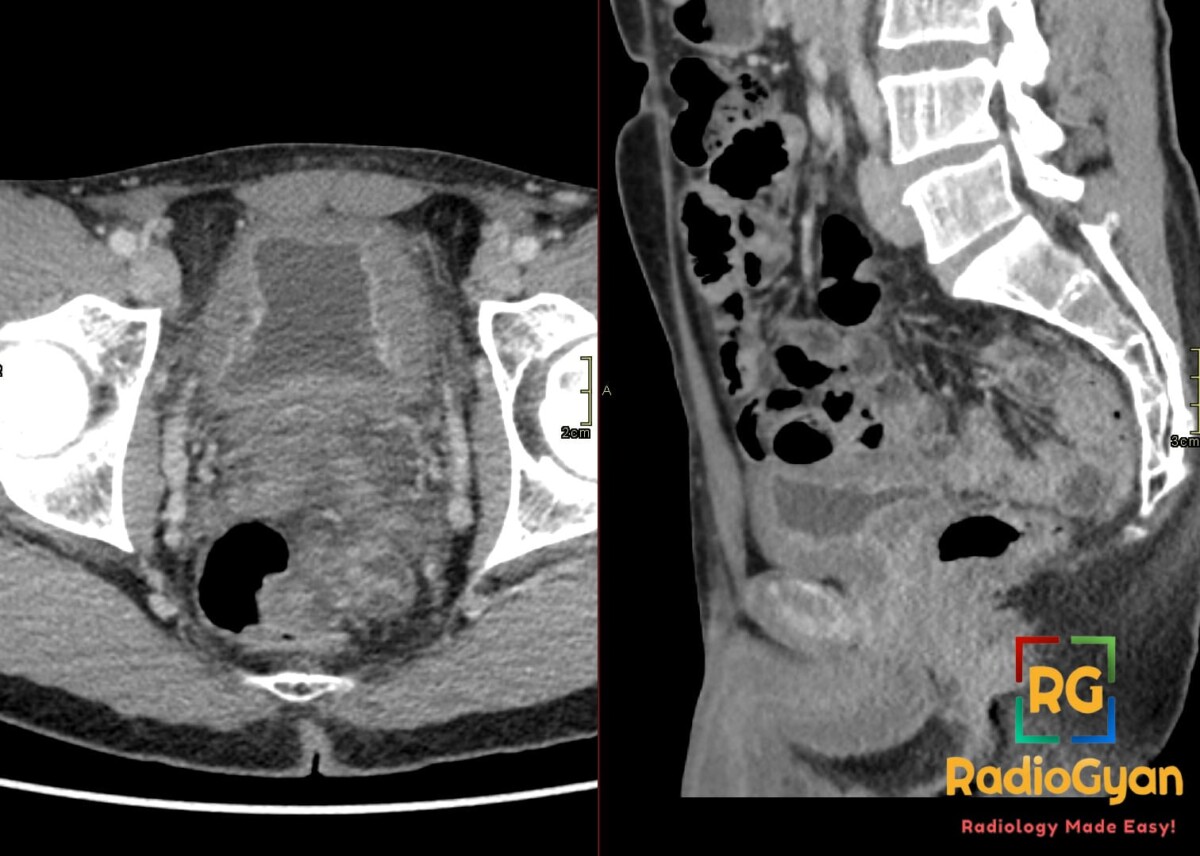 Axial and sagittal pelvic CT showing severe diffuse urinary bladder wall thickening with reduced capacity.