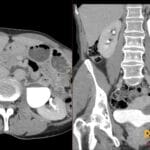 Axial and coronal CT urogram showing a left UPJ stricture with hydronephrosis and calyceal dilatation