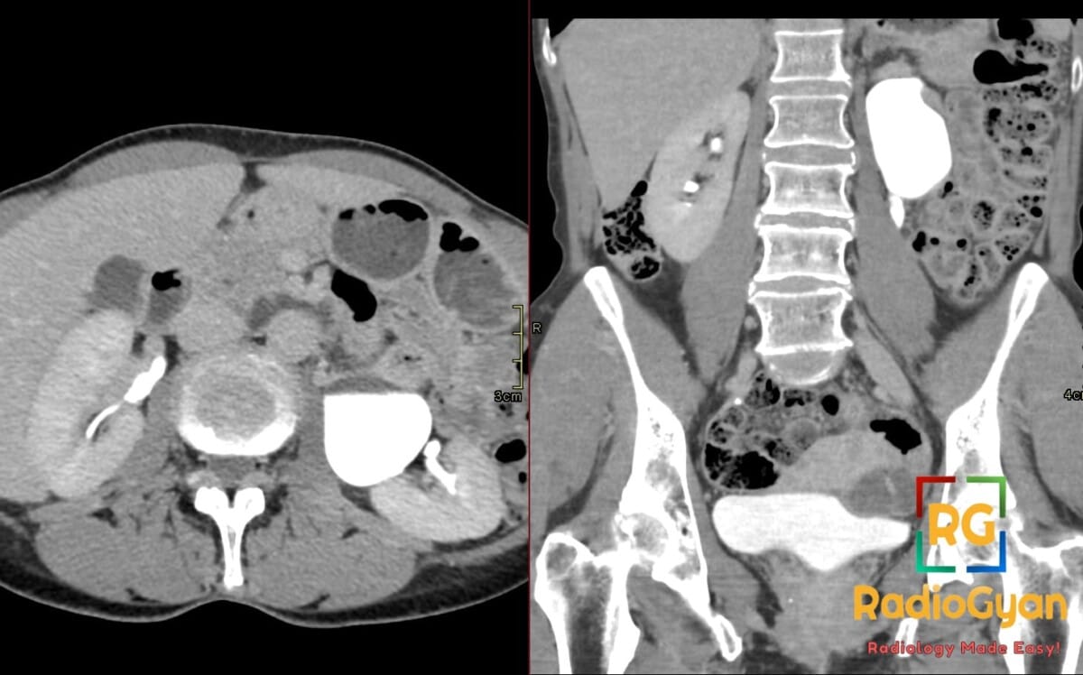 Axial and coronal CT urogram showing a left UPJ stricture with hydronephrosis and calyceal dilatation