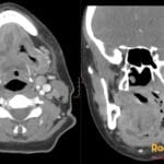 Axial and coronal contrast CT neck shows Ludwig angina from tonsillitis, with floor-of-mouth edema and submandibular gas.