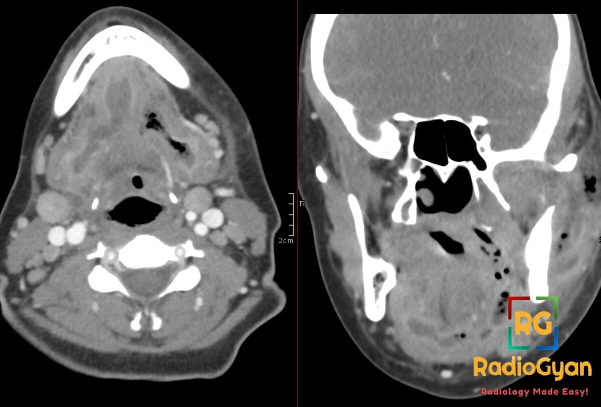 Axial and coronal contrast CT neck shows Ludwig angina from tonsillitis, with floor-of-mouth edema and submandibular gas.