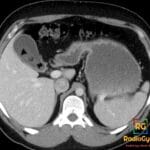 Axial CT showing a gallstone within the gallbladder with a triradiate Mercedes-Benz sign from gas-filled fissures