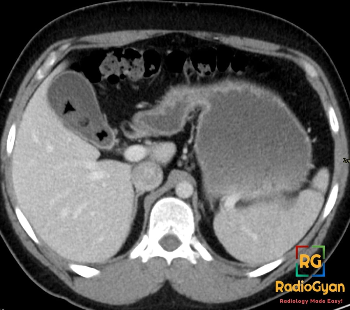 Axial CT showing a gallstone within the gallbladder with a triradiate Mercedes-Benz sign from gas-filled fissures