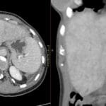Axial and coronal abdominal CT showing mottled mosaic liver enhancement pattern characteristic of hepatic congestion.