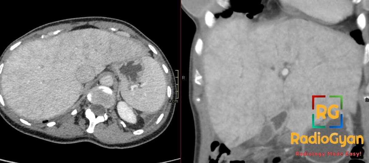 Axial and coronal abdominal CT showing mottled mosaic liver enhancement pattern characteristic of hepatic congestion.