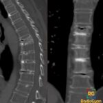 Sagittal CT of the thoracic spine showing osteoporotic vertebral compression fracture with intravertebral vacuum cleft sign