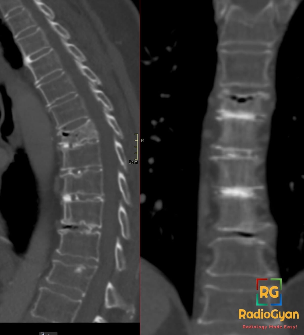 Sagittal CT of the thoracic spine showing osteoporotic vertebral compression fracture with intravertebral vacuum cleft sign