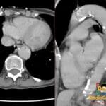 Axial and sagittal CTA images demonstrating a penetrating atherosclerotic ulcer in the descending thoracic aorta.