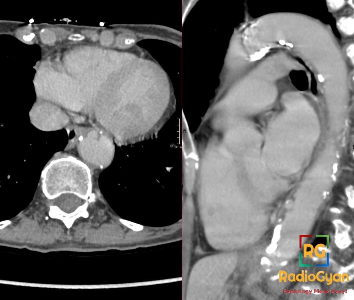 Axial and sagittal CTA images demonstrating a penetrating atherosclerotic ulcer in the descending thoracic aorta.