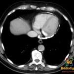Axial chest CT showing pericardial calcification suggestive of constrictive pericarditis