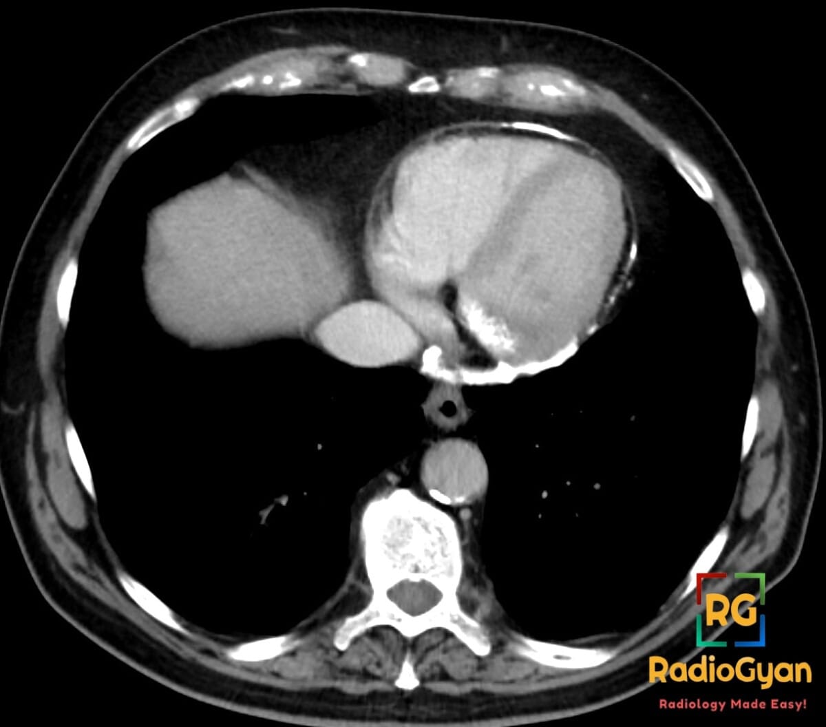 Axial chest CT showing pericardial calcification suggestive of constrictive pericarditis
