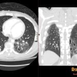 Axial and coronal chest CT show left lower-lobe pulmonary contusion and laceration with cavitary traumatic pneumatoceles.