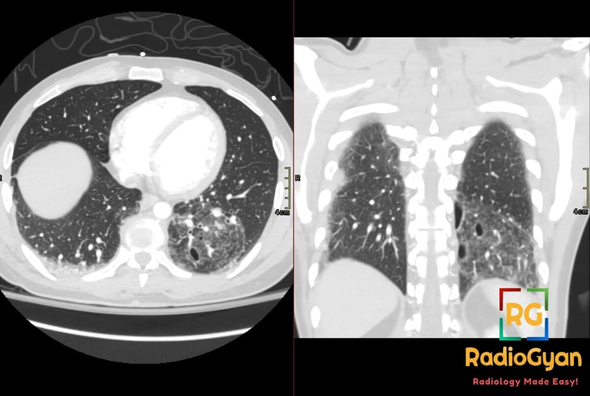 Axial and coronal chest CT show left lower-lobe pulmonary contusion and laceration with cavitary traumatic pneumatoceles.