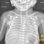 Supine frontal chest radiograph of a premature neonate showing bilateral fine reticulogranular opacities and low lung volumes