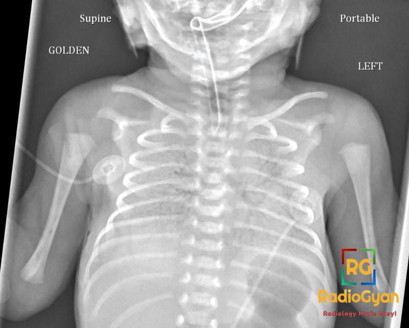 Supine frontal chest radiograph of a premature neonate showing bilateral fine reticulogranular opacities and low lung volumes