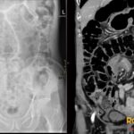 Supine abdominal radiograph and coronal CT showing sigmoid volvulus with coffee-bean dilation and mesenteric whirl sign
