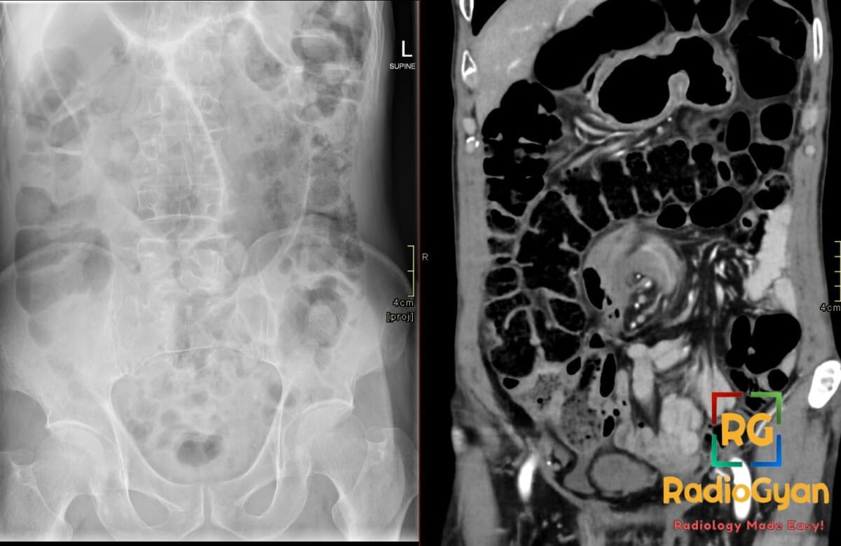 Supine abdominal radiograph and coronal CT showing sigmoid volvulus with coffee-bean dilation and mesenteric whirl sign